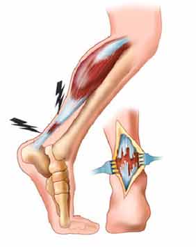 Article inflammation and rupture of the Achilles tendon