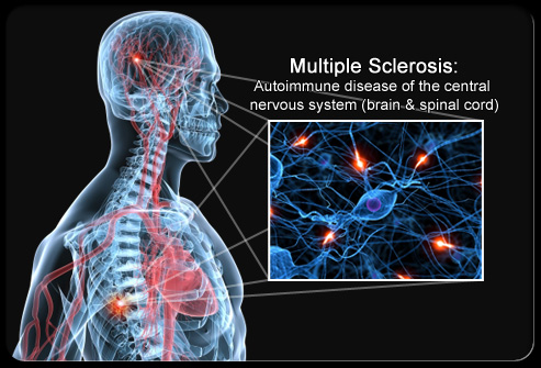 Paper Multiple Sclerosis